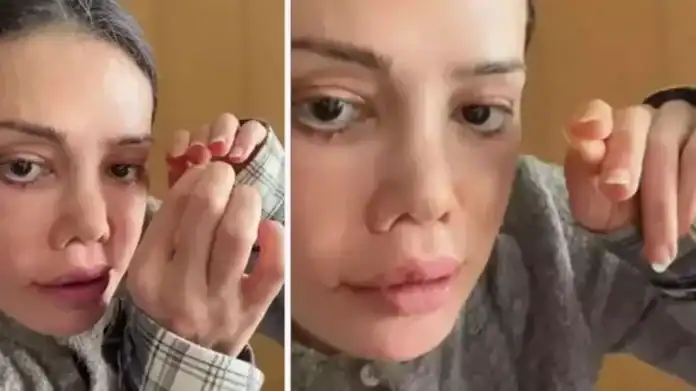 Ceran'dan Şaşırtan Paylaşım Yüz Nakli Sonrası Kaşında Saç Çıktı